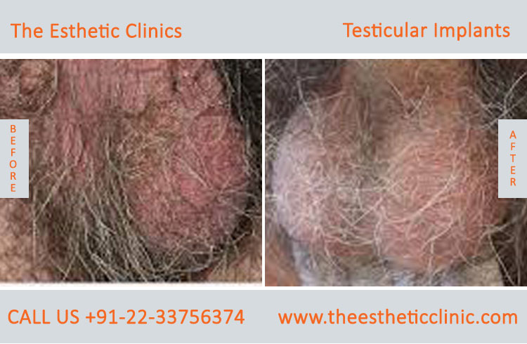 Testicular Implant surgery before after photos in mumbai india (2)